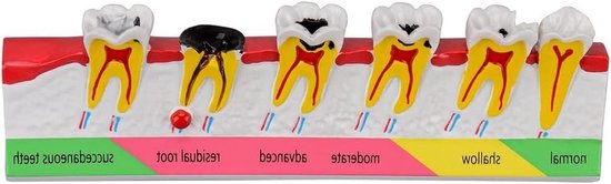 Tandbederf Model - Tand Anatomie - Onderwijs & Demonstratie - Gedetailleerde Structuren - 15 x 4 x 4 cm - Kleurrijk